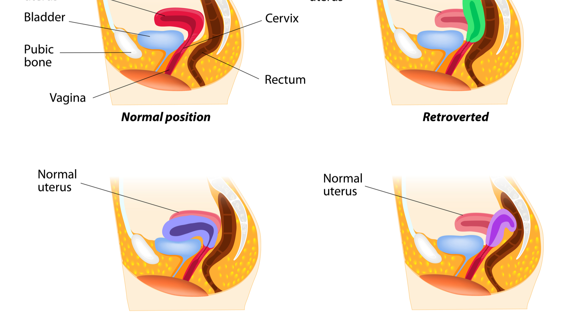 Uterul retrovers: semnificatie, diagnostic si tratament