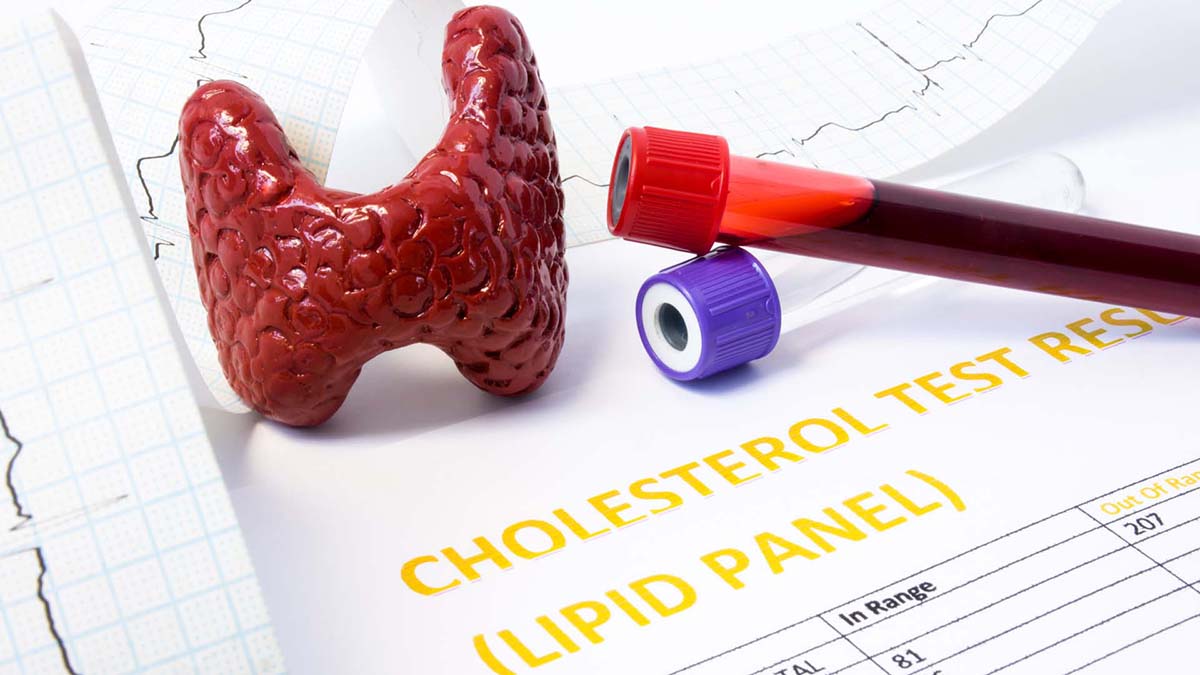 Care sunt valorile de referinta ale colesterolului la cei care au peste 50 de ani