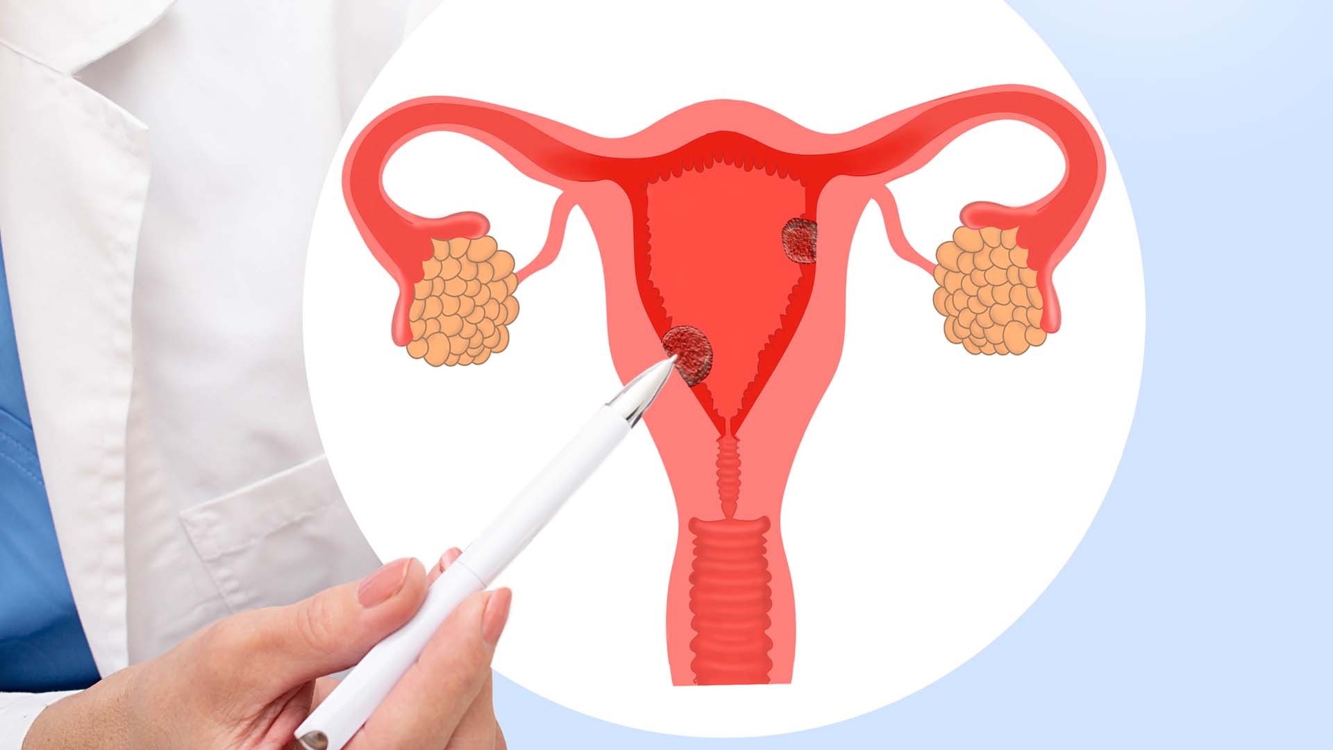 Polipii uterini: ce sunt, cum se manifestă, dar și cum se tratează