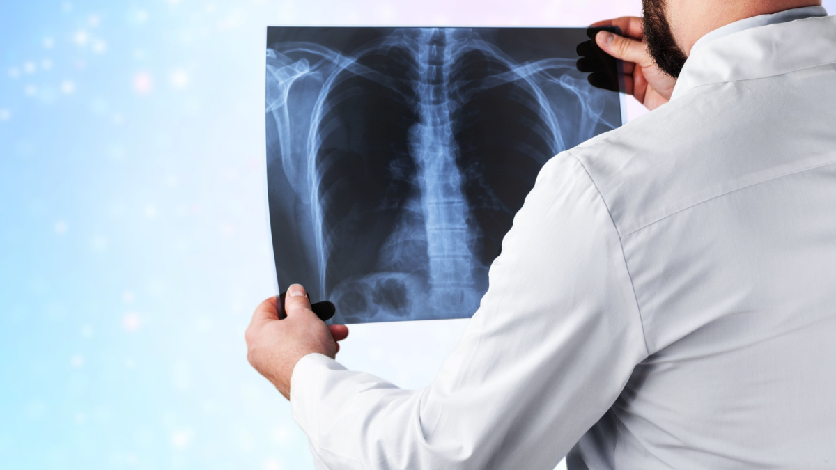 Diagnosticul nodulilor pulmonari: de la screening la terapie