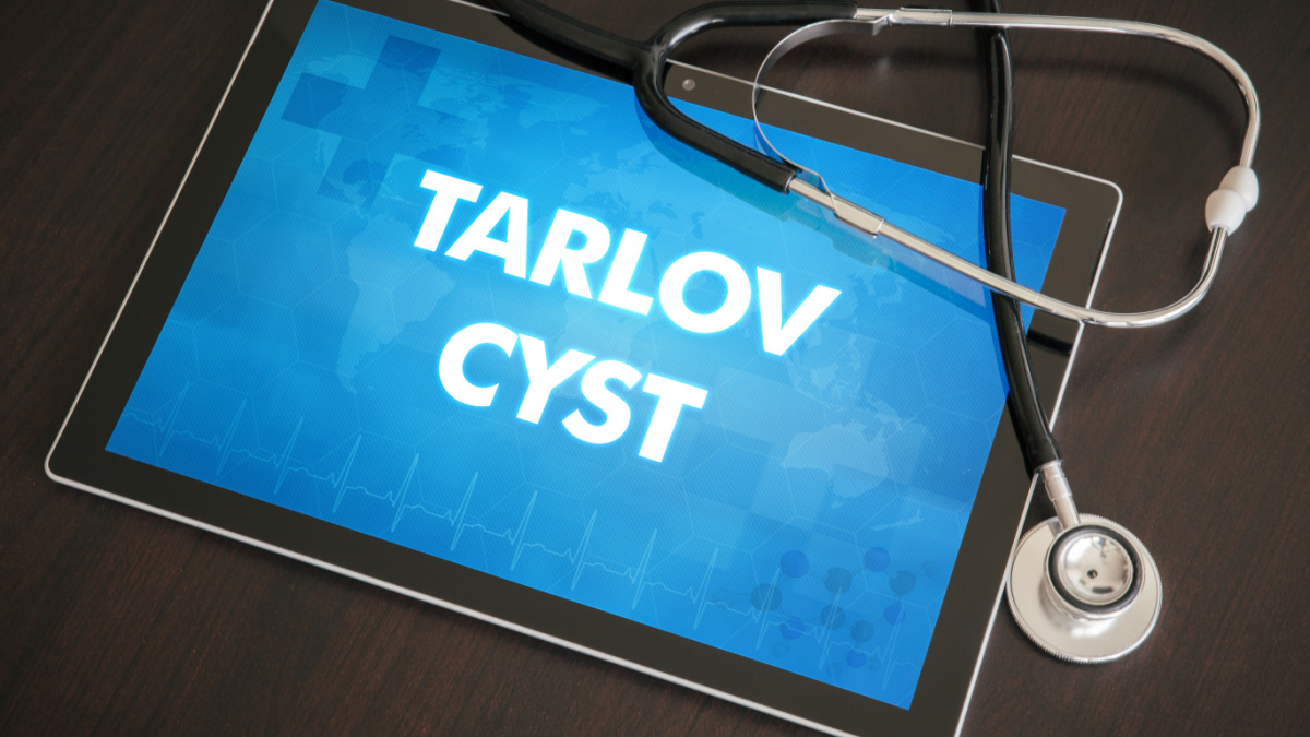 Chisturile Tarlov: cauze, simptome & tratament