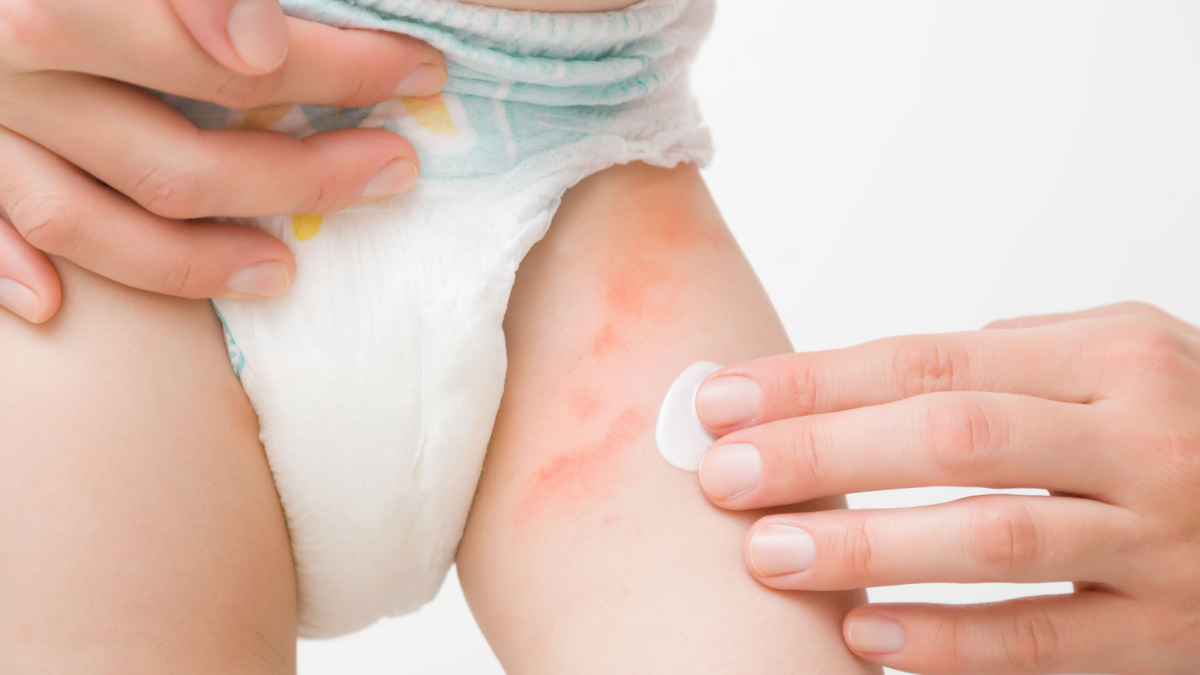 Iritatiile pielii la bebelusi: cauze, simptome si tratament