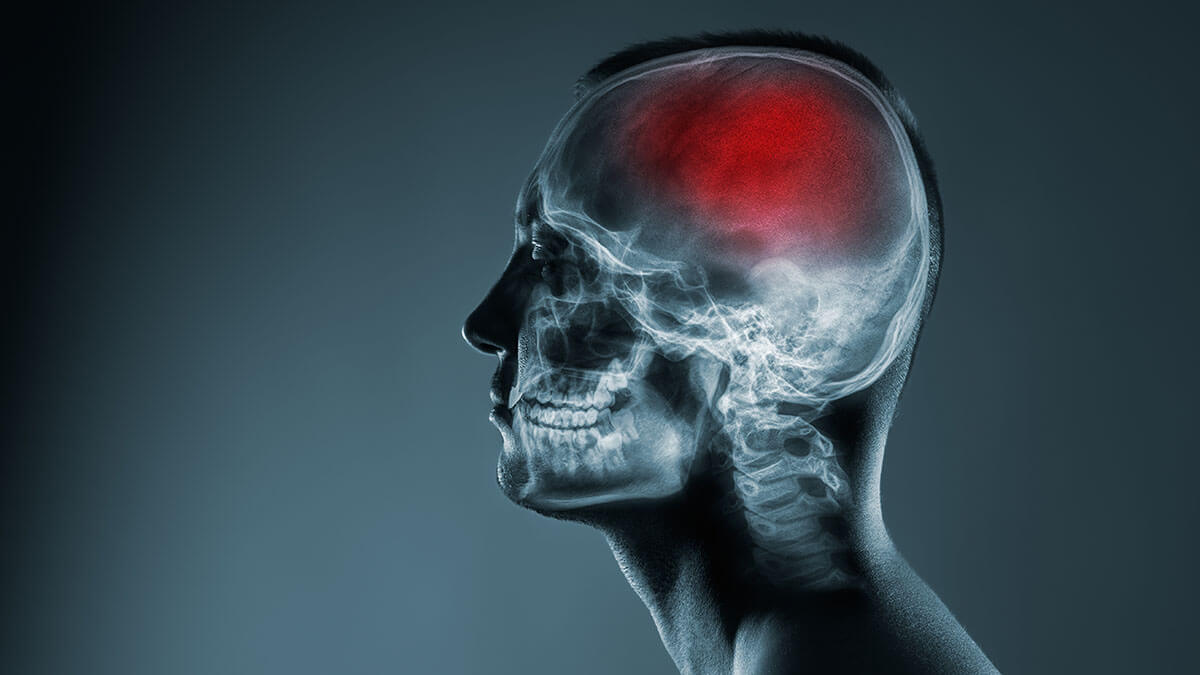 Accidentul vascular cerebral hemoragic: simptomatologie si debut