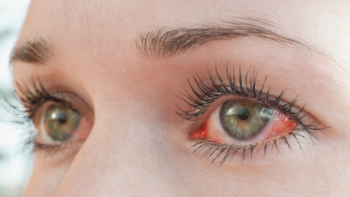 Posibil diagnostic pentru ochii rosii sau sensibili