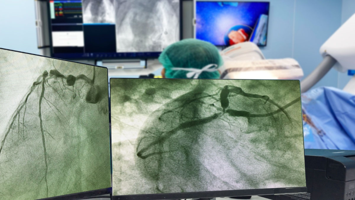 Angiografia coronariană: ce este, cum se efectuează, când este indicată