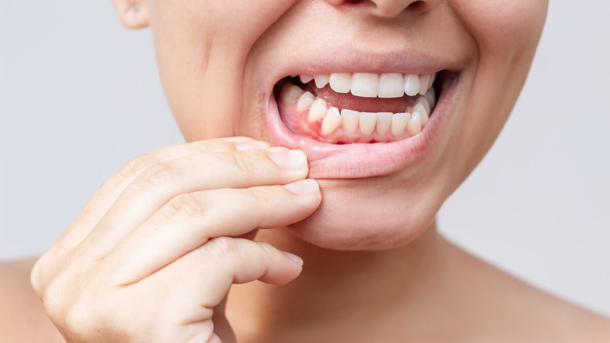 Modificarile gingiei: ce afectiuni poate indica o gingie inflamata?