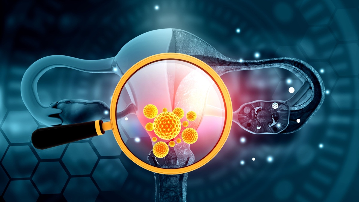 Infectia cu trichomonas: cum se manifesta si cum se vindeca