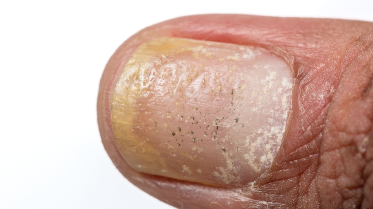 Modificări ale unghiilor la pacienții cu psoriazis și artrită psoriazică