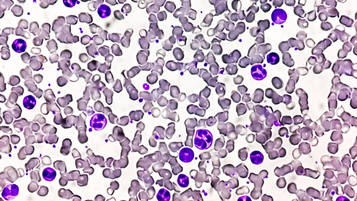 Totul despre leucemia granulocitară (leucemie mieloidă cronică)