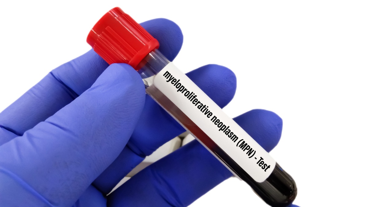Totul despre neoplasmele mieloproliferative cronice