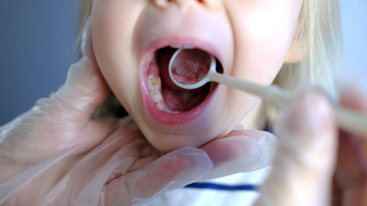 Caria de biberon: de ce apare si cum poate fi prevenita