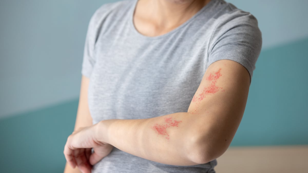 Cum reducem durerea in zona zoster?