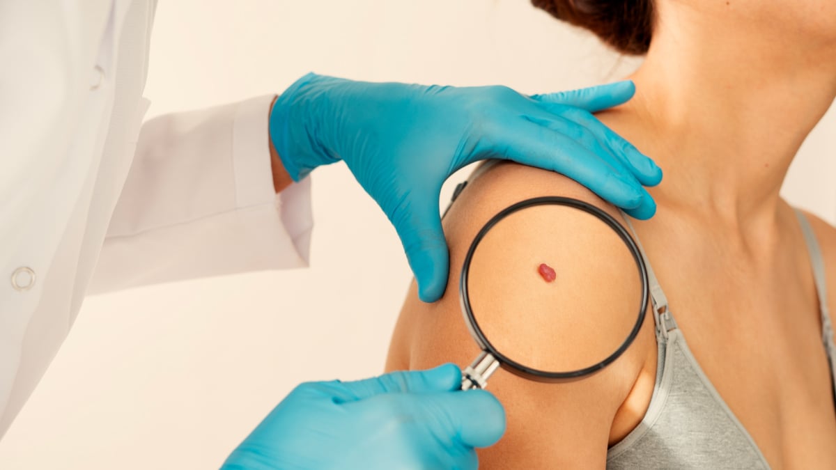 Tot ce trebuie să știi despre noul vaccin personalizat împotriva melanomului